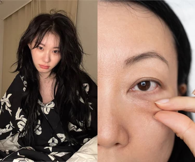 如何分辨3大類型眼袋？教你6招改善眼袋︰早晚眼霜功效各不同、水腫型眼袋避吃1類食物！什麼情況需要醫美去眼袋？